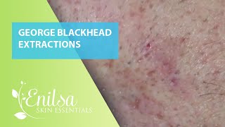 Blackheads Extractions on George [upl. by Lacey]