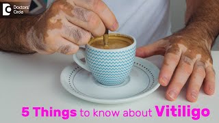 Vitiligo Types Symptoms Causes Treatment amp Recovery  Dr Divya Sharma  Doctors Circle [upl. by Eneirda]