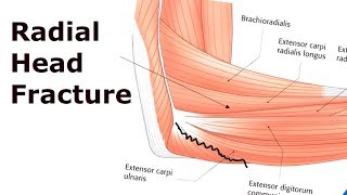 Hip Dislocations and Femoral Head Fractures [upl. by Kunz]