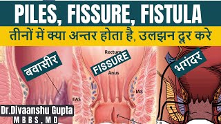 Piles Fissure Fistula mein kya antar hai बवासीरभगंदर फिशर में क्या अन्तर है सम्पूर्ण जानकारी [upl. by Eecak]