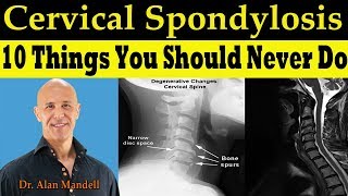 CERVICAL SPONDYLOSIS 10 Things You Should Never Do  Dr Alan Mandell DC [upl. by Madigan]