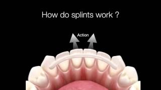 How Do Dental Splints Work [upl. by Jasmin720]