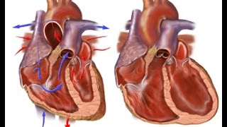 Congestive Heart Failure [upl. by Christin]