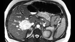 Liver Hemangioma [upl. by Kizzie]