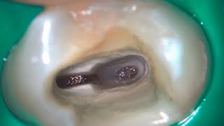 DRendo  Deep partial pulpotomy in a maxillary premolar [upl. by Helms]