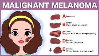 Melanoma  Symptoms signs diagnosis and management [upl. by Iramohs448]