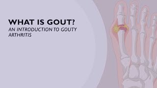 Acute Gout Treatment  How You Can Relieve the Sudden Onset of Pain 5 of 6 [upl. by Arza]