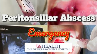 Peritonsillar Abscess Emergency and Needle Aspiration [upl. by Canty]