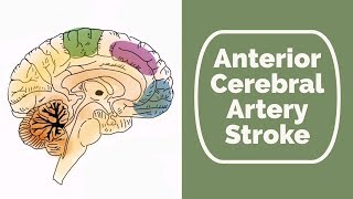 Anterior Cerebral Artery Stroke [upl. by Adnawaj]