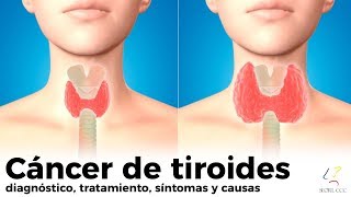 CÁNCER DE TIROIDES diagnóstico tratamiento síntomas causas [upl. by Adriaens]