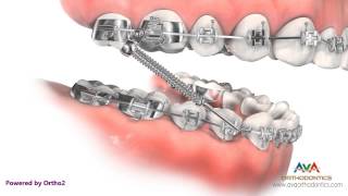 Orthodontic Treatment for Overjet Overbite  Forsus Appliance [upl. by Uzial303]