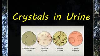 Urine Examination3 Crystals [upl. by Tillie742]