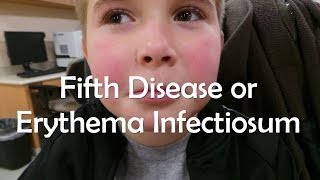 Fifth Disease or Erythema Infectiosum [upl. by Fiertz]