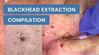 Extraction Satisfaction Blackhead Removal  CONTOUR DERMATOLOGY [upl. by Xerxes]