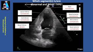 Wall Motion Abnormality Part II cases amp practice [upl. by Acysej271]