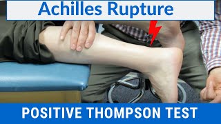 How to Perform a Thompson Test on a Patient with a COMPLETE ACHILLES RUPTURE [upl. by Saundra]