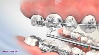 Orthodontic Treatment for Overjet Overbite  Esprit Appliance [upl. by Atinauj]