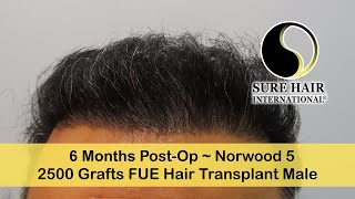 Clinic amp Hair Transplant Procedure Overview  Natural Transplants South Florida Dave [upl. by Elicia]