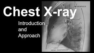 Chest Xray Introduction and Approach [upl. by Anirtik]