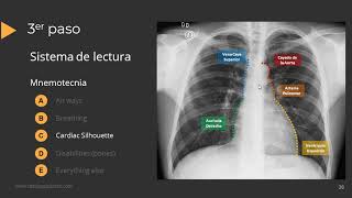 Tutorial Radiografía de Torax [upl. by Mathews963]