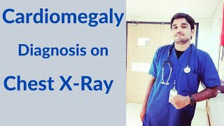 Cardiomegaly diagnosis on XRays [upl. by Ytsirhk563]