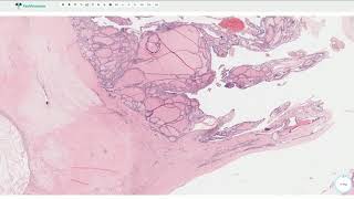 Multinodular Goiter  Thyroid Gland Histopathology [upl. by Justina]