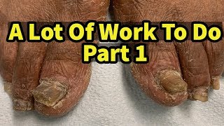 Severe Fungal Fungus Toenails A Lot Of Work To Do Part 1 [upl. by Donnamarie]