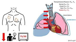 Thoracic Trauma [upl. by Yaf]