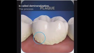 Stage 1 of Tooth Decay Demineralization [upl. by Noraha]