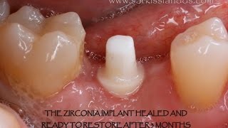 Zirconia Implant [upl. by Ellita]