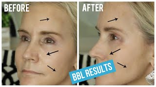 BBL LIGHT TREATMENT BEFORE AND AFTER  MY BBL LASER TREATMENT FOR BROWN SPOTS amp SPIDER VEINS [upl. by Asirrom]