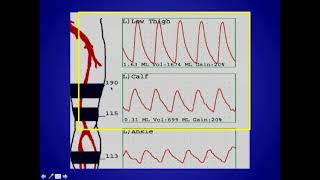 How to Perform and Interpret Peripheral Arterial Doppler Examinations [upl. by Gunnar]