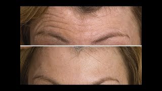 Face Exercise to Lift amp Tighten Your Forehead  FACEROBICS® [upl. by Lindsley462]