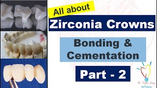 Zirconia Crowns  CEMENTATION vs BONDING [upl. by Rhee183]