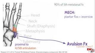 5th Metatarsal Fractures [upl. by Bixby54]