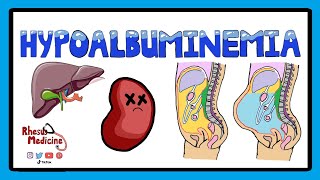 Hypoalbuminemia  Functions of Albumin in the Body  Pathophysiology of Hypoalbuminemia [upl. by Enilrac]