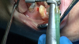 Implantes endodoncia coronas  Odontologia Multidisciplinar Dentistry Multidisciplinary [upl. by Turnbull]