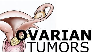 Ovarian Pathology amp Tumors [upl. by Tychon]