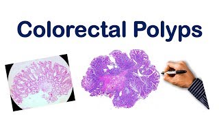 Colorectal Polyps USMLE STEP NCLEX COMLEX [upl. by Cicely]