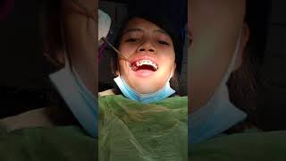 4 Premolar extraction for braces [upl. by Ahsaenat]