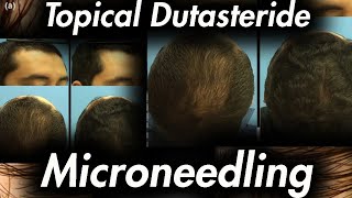 Microneedling and Topical Dutasteride [upl. by Booker]