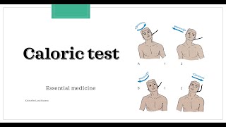 Caloric test Essential medicine [upl. by Llerej]