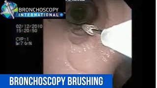 Comprehensive Bronchoscopy with Endobronchial Ultrasound [upl. by Eckel]