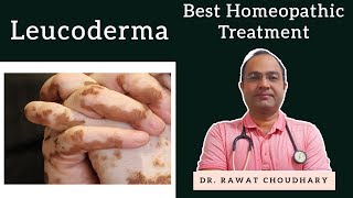 Leucoderma  सफेद दाग Best Homeopathic Treatment [upl. by Sirraj]