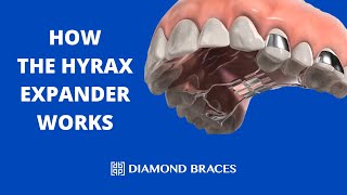 How The Hyrax Expander Works [upl. by Miguela703]