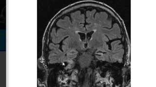 MRI in Epilepsy [upl. by Ayak]