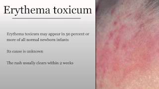 Erythema Toxicum [upl. by Alrad897]