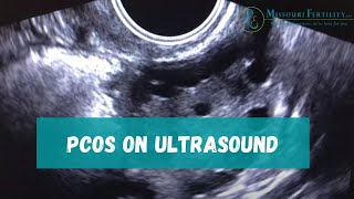 PCOS Sonogram and Discussion [upl. by Aramad]