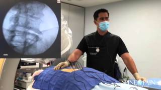 Radiofrequency Ablation Procedure [upl. by Yntruoc]