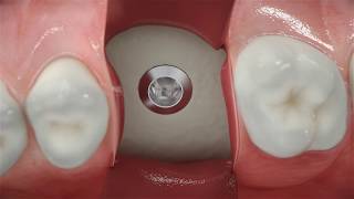 Straumann® BLX  Conventional posterior implant placement [upl. by Jauch]